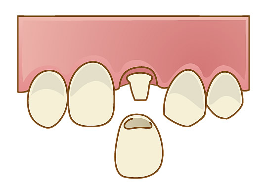 クラウン(被せもの)