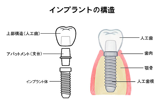 インプラントの構造