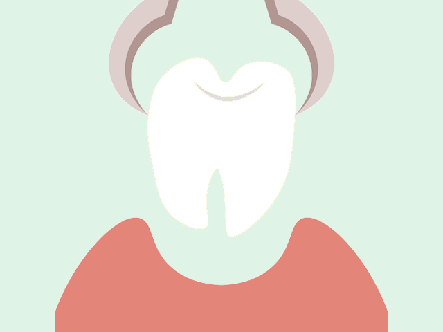 私の親知らずは抜いた方がいい?