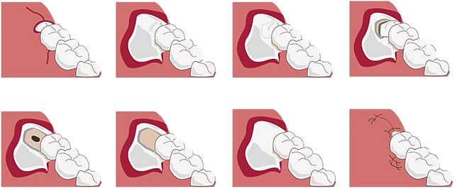 どうやって親知らずを抜くの?