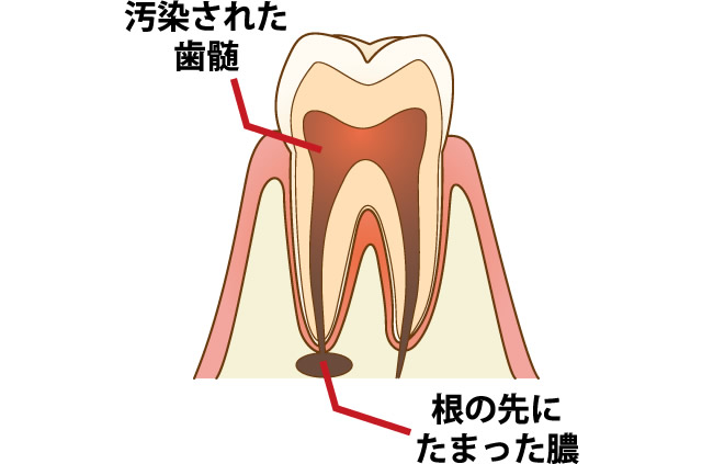 根管治療とは