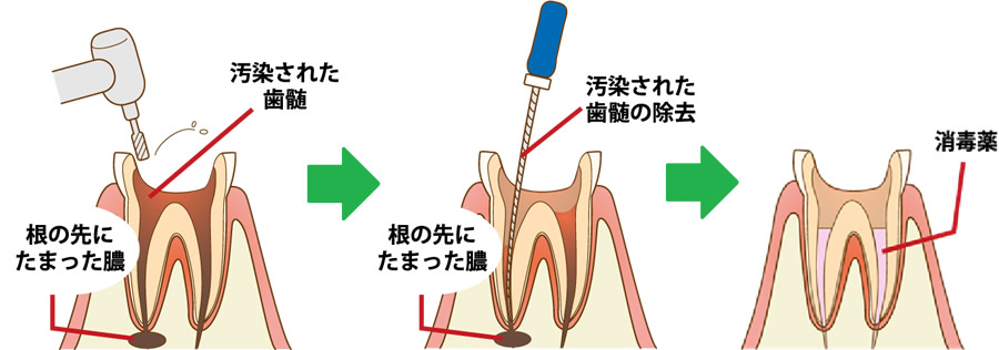 根管治療